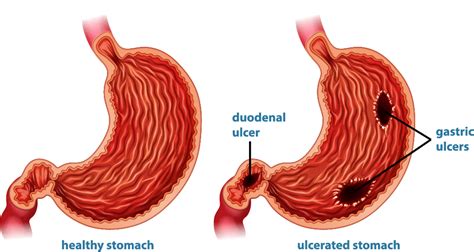 Peptic Ulcer Disease Overview And How Is It Treated By Alfa Gastro Medium