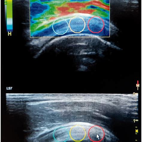 Supraspinatus Tendon Elasticity Measurement By Quantified Elastography