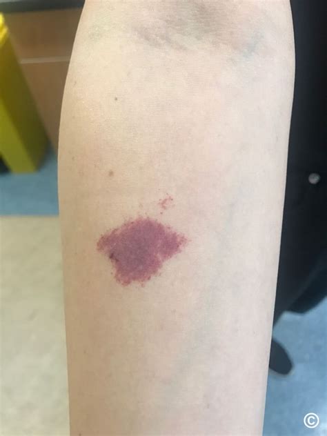 Port Wine Birthmark On Leg