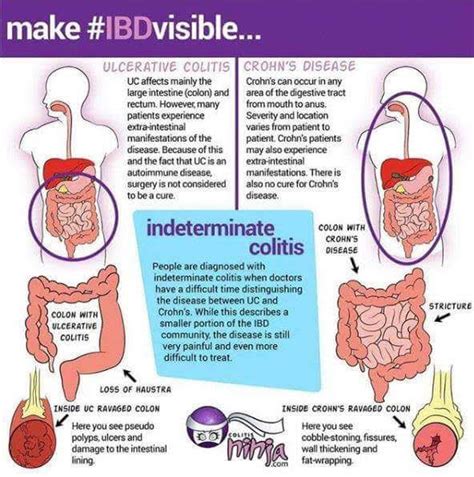 What's Indeterminate Colitis(IC), Ulcerative Colitis(UC) & Crohns ...