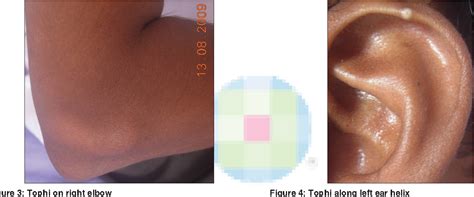 Figure 2 from Tophi as first manifestation of gout. | Semantic Scholar