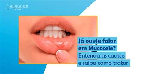 Bolha Embaixo Da Língua Mucocele - Já Ouviu Falar Em Mucocele? Entenda As Causas E Saiba Como Tratar - Dr ...