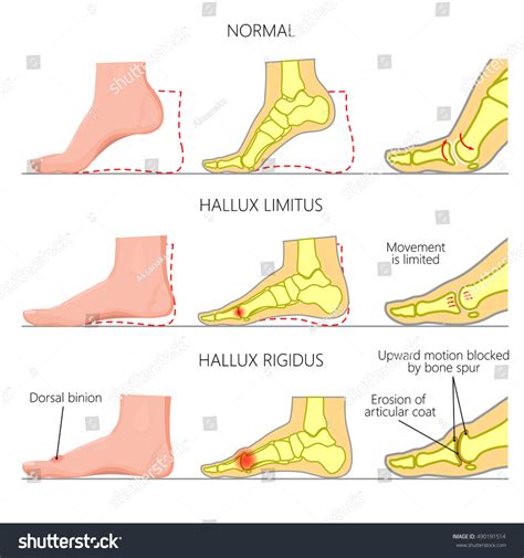 45 Hallux rigidus Images, Stock Photos & Vectors | Shutterstock