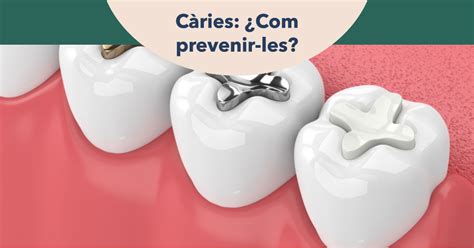 Cómo prevenir las caries dentales Guía completa Clínica dental Albiol