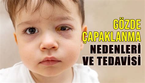 G Z Apaklanmas Nedenleri Ve Tedavisi