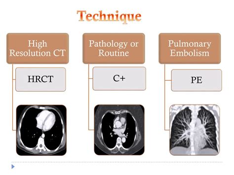 PPT - Chest CT PowerPoint Presentation, free download - ID:6995479