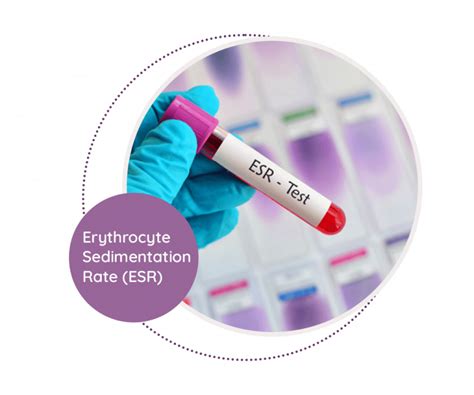 Erythrocyte Sedimentation Rate MediScan Lab