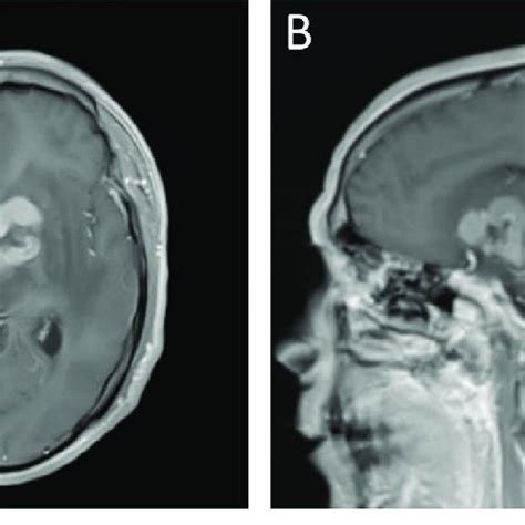 Case 2: Enhanced MRI of primary central nervous system lymphoma With ...