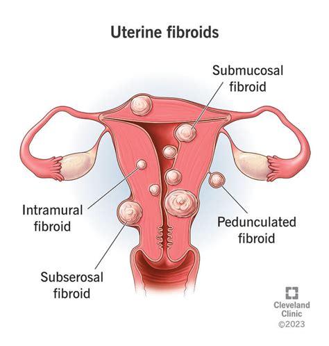 An Overview Of Uterine Fibroids And Fertility Rpsd Blog