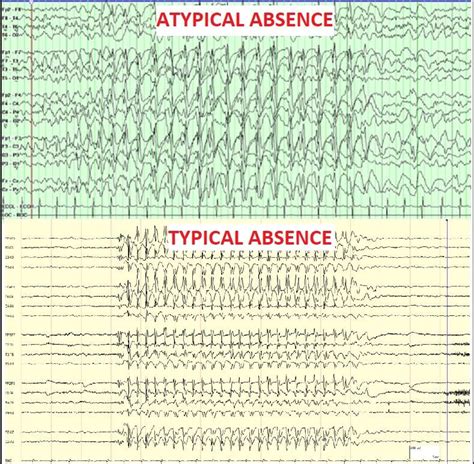 Atypical Absence Seizure Vs Typical Absence Seizure Rneurology