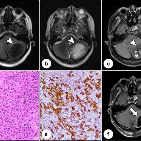 Radiological And Pathological Profiles Of Case 5 Magnetic Resonance