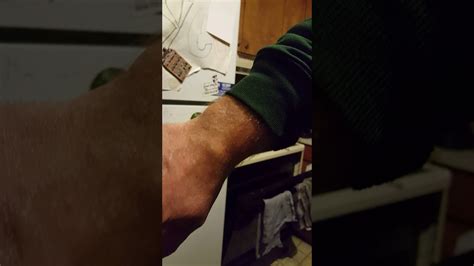 Ganglion Cyst Popping Recurent Wrist Cyst Popped With Book Youtube