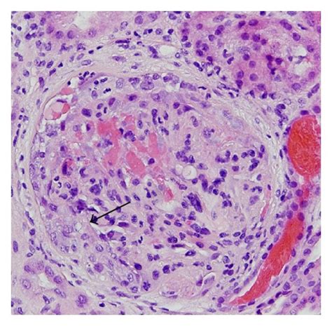 Kidney Biopsy A Glomerulus Showing Cellular Crescent Arrow With