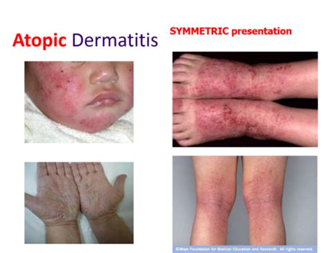 Dermatitis Flashcards Quizlet