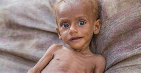 Guerra En Yemen Ni Os Han Muerto Por Malnutrici N Metro