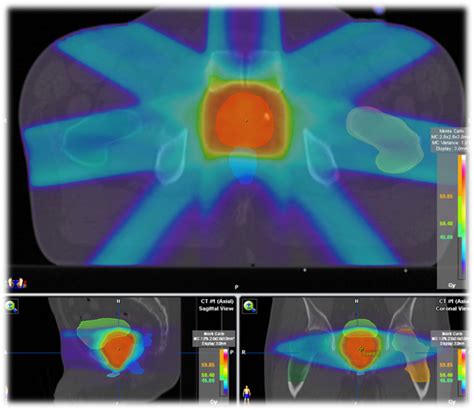 C Ncer De Pr Stata Radioterapia Hm