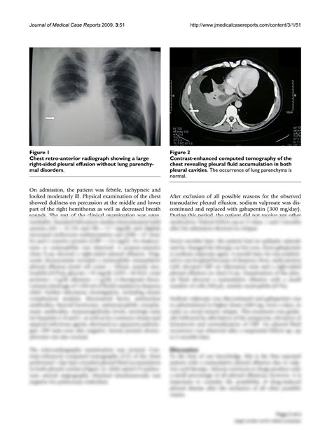 Solution Sodium Valproate As A Cause Of Recurrent Transudative Pleural