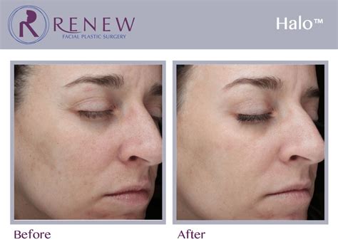 Laser Skin Treatment Services In Mn Renew Plastic Surgery