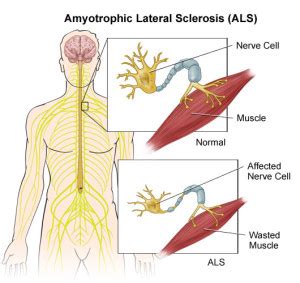 Amyotrophic Lateral Sclerosis Als Nursing Care Plan Management