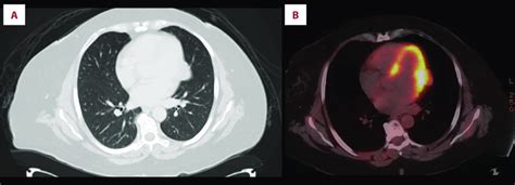 (A) CT scan of the lung showing suspicious nodule at the lingula ...