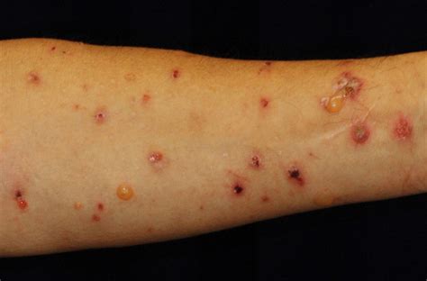 A Risk Factor For Drug Induced Skin Disease Identified