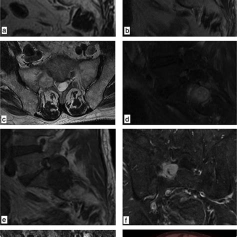 Sagittal Tse T2 Weighted Image July 2015 Showing No Abnormal Findings