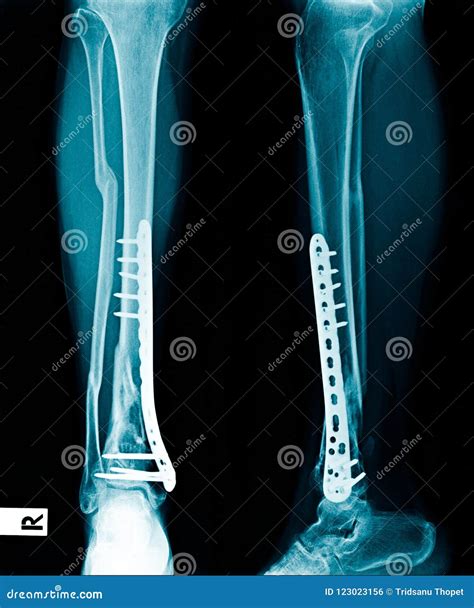 Fixed tibia bone x-ray stock photo. Image of knee, fixation - 123023156