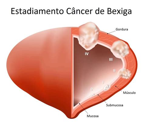 Sintomas de câncer de bexiga 6 formas de maximizar o tratamento