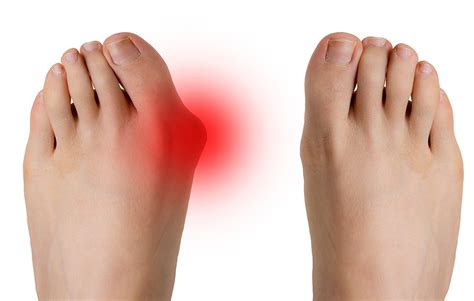 Bunion Surgery For Pain Relief Burlington County Foot Ankle