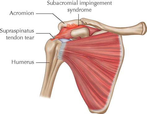 Subacromial Impingement Syndrome Is It Time To Finally Abandon The Term