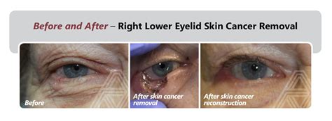 Eyelid And Facial Skin Cancer Triad Eye Institute