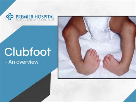 Clubfoot Causes And Symptoms Premier Hospital