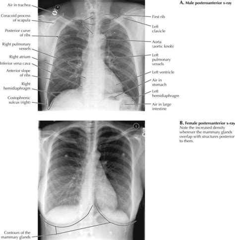 Thorax Radiology Key