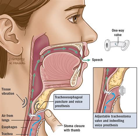 Speech And Swallow Therapy ‣ Thanc Guide