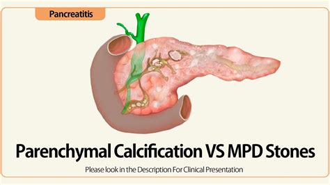 Linear Eus Parenchymal Calcifications Vs Mpd Stones Youtube