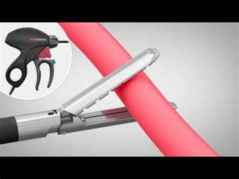 marseal   intelligent vessel sealing    dimension youtube