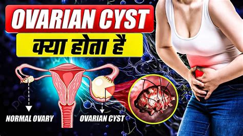 Ovarian Cyst ओवरी में गाँठ सिस्ट Ovarian Cyst क्या होता है क्यों