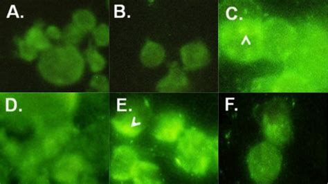 Hopkins Researchers Id New Biomarker For Colorectal Cancers Johns