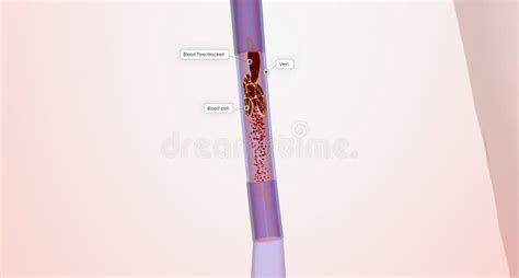 The Deep Vein Thrombosis Complications Stock Illustration ...