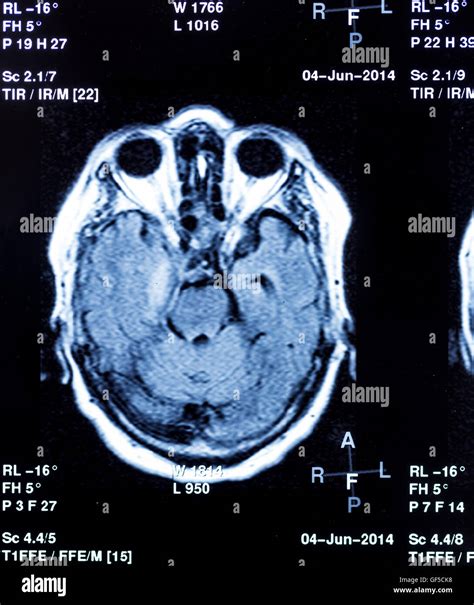 Pet Scan Cancer Hi Res Stock Photography And Images Alamy