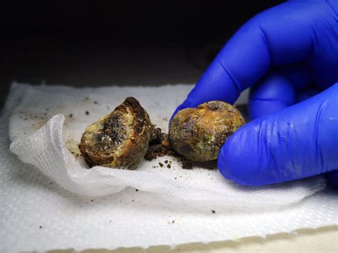 Gallstones Close Up Calculi In The Hands Of The Surgeon After