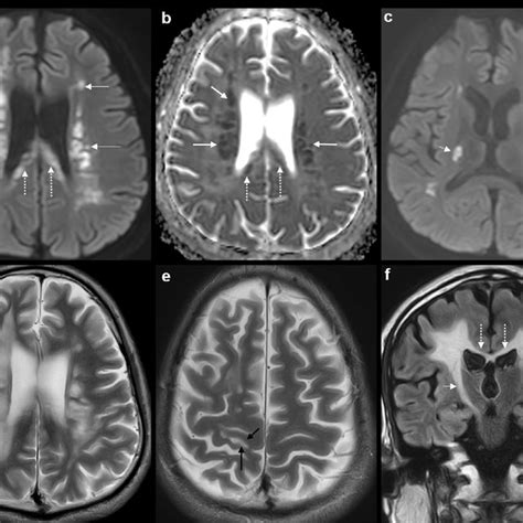 Second Mri Brain Study At 5 Months Axial Dwi Image A And Adc Map