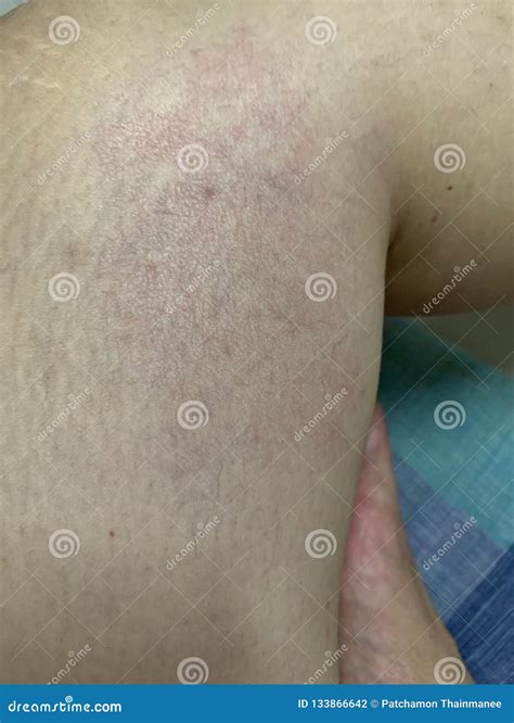 Skin stock photo. Image of rashes, body, capillaries - 133866642