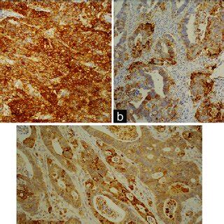 A C A Pd L Staining In A Tumor With Medullary Features B