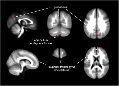 Frontiers Effects Of Acupuncture On The Brain In Primary Insomnia A