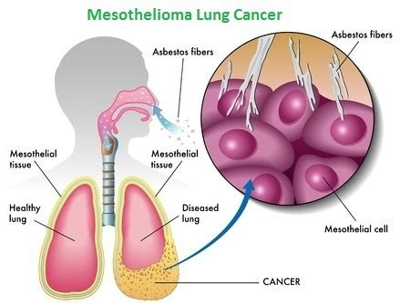 Mesothelioma Lung Cancer - Microbiology Notes