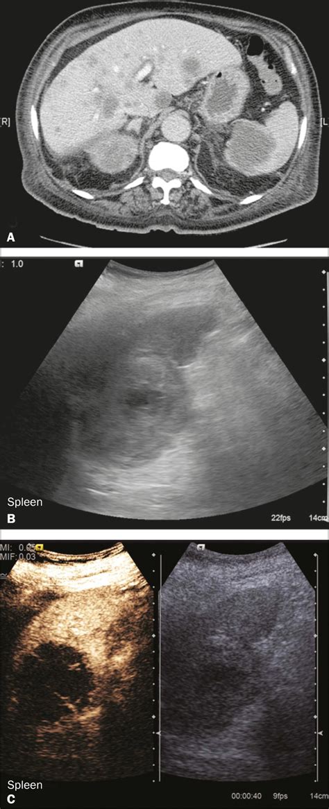 Common And Uncommon Features Of Focal Splenic Lesions On Contrast Enhanced Ultrasound A