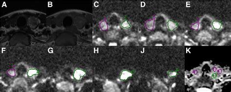 Images Obtained From A 28 Year Old Female Patient With Histologically