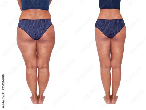 Comparison Before And After Weight Loss Women S Legs The Result Of