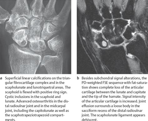 27 Osteoarthritis Radiology Key